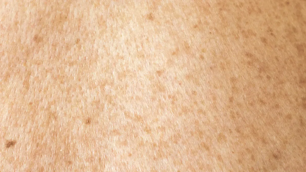 Närbild på hud med bruna pigmentfläckar och slät yta